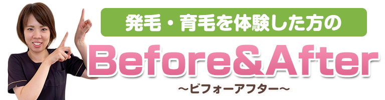 下関 発毛ビフォーアフター