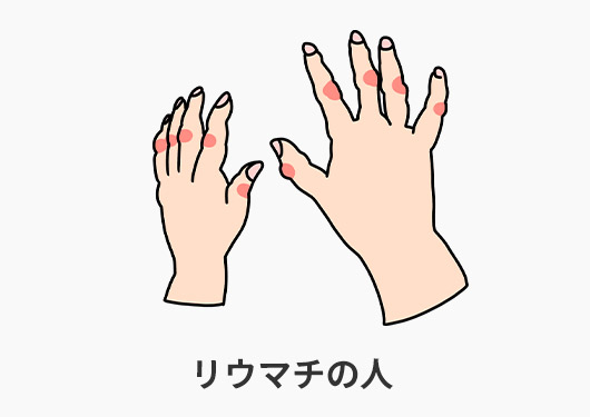 下関 腱鞘炎になりやすい人
