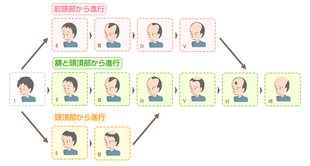 下関 男性の薄毛パターン
