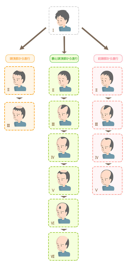 下関 男性の薄毛パターン